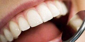 پوسیدگی‌های دندان