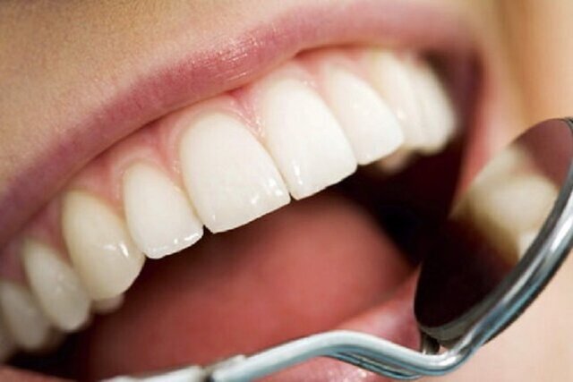 پوسیدگی‌های دندان